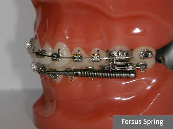 Forsus Spring Orthodontic Appliance