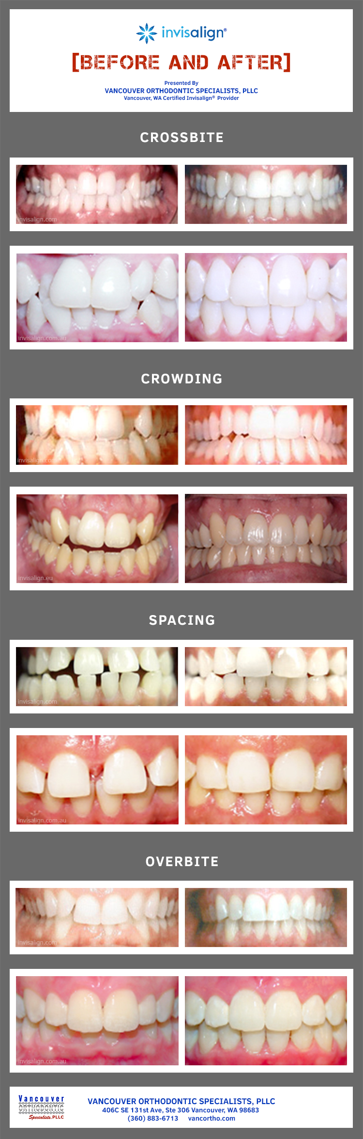 results of Invisalign orthodontic treatment