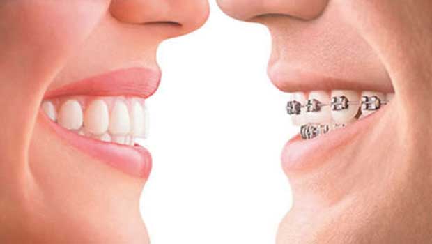 Invisalign Vancouver WA vs braces and pros and cons of each