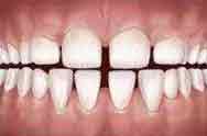 spacing or gaps between teeth