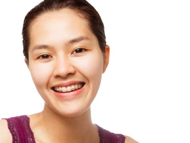Young woman wearing a retainer