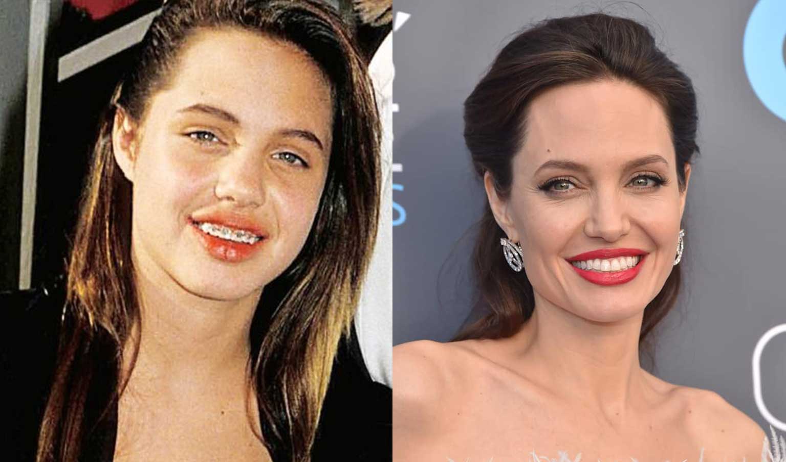 Celebrity Angelina Jolie before and after wearing metal braces