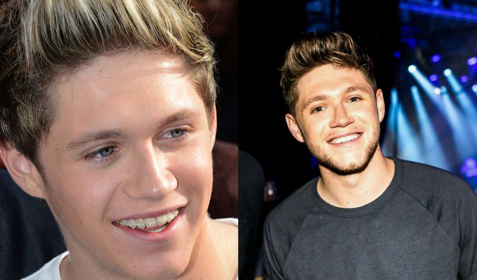 Niall Horan wearing braces and after braces