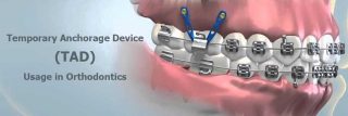 Orthodontic Temporary Anchorage Device (TAD), Mini-Screw, Mini-Implant