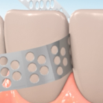 interproximal reduction during orthodontic treatment